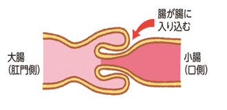 腸重積症とは